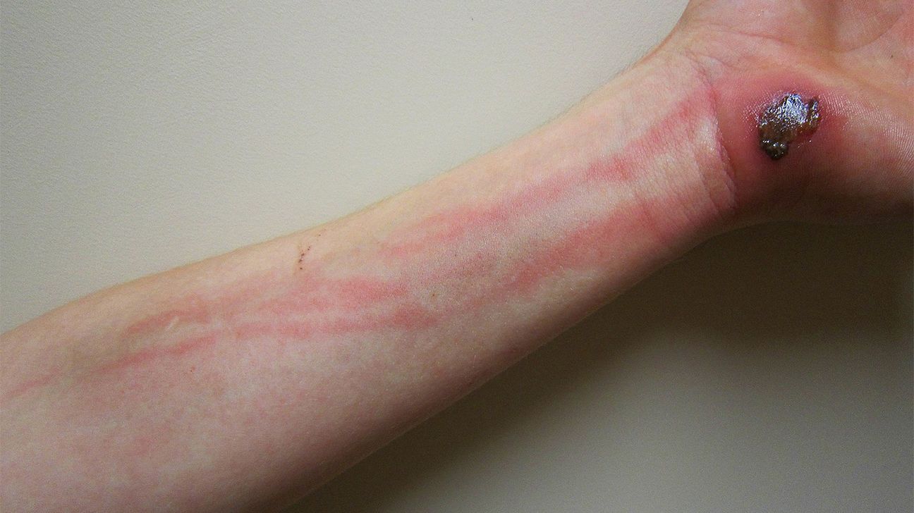 Infected Cut Symptoms - How To ID An Infected Wound, From A Derm