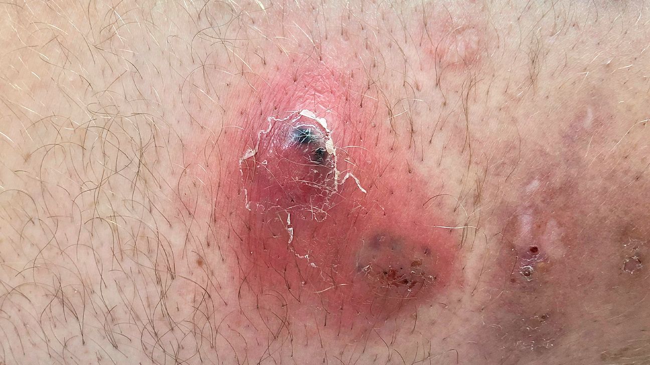 Hidradenitis suppurativa on the thighs: Pictures and more