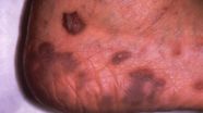 Kaposis Sarcoma