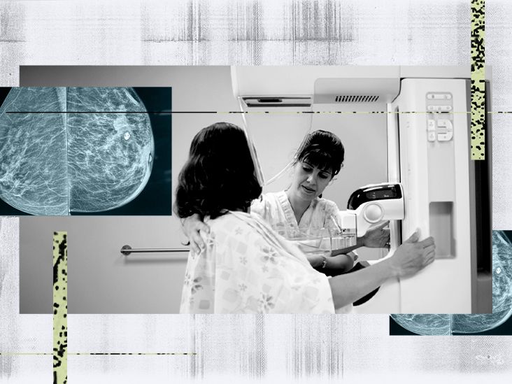 mammogram-for-stage-1-breast-cancer