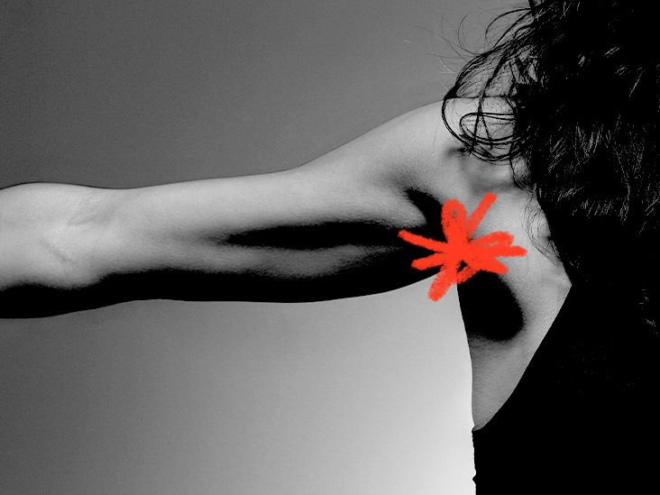 化膿性汗腺炎の写真