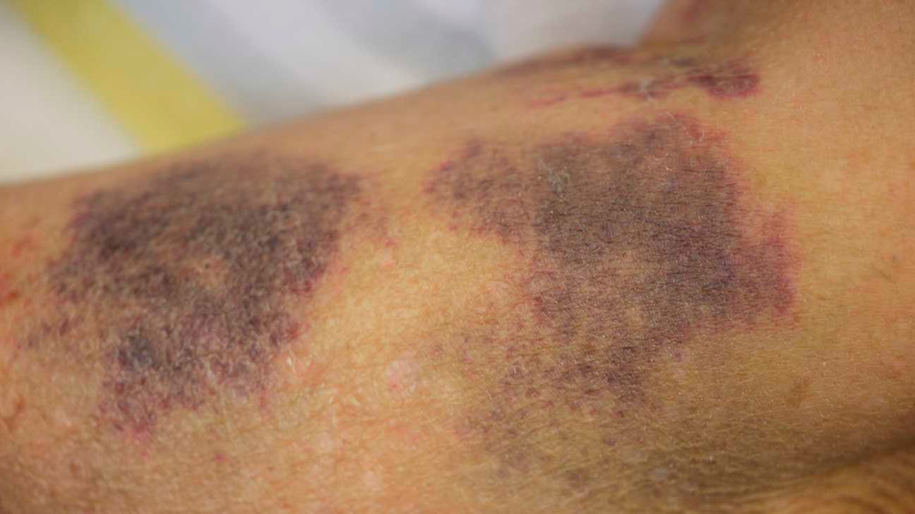 Breaking out in a rash could be a sign of CANCER - here's how tell if you  are at risk