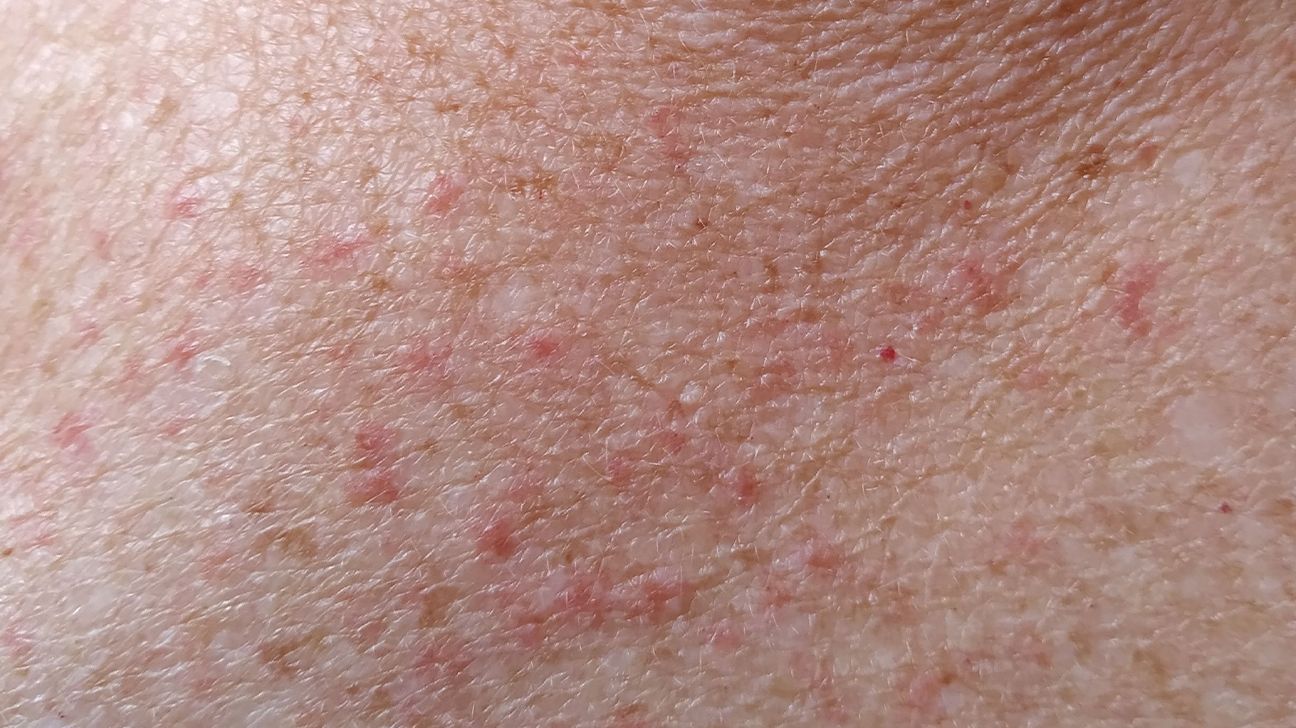 Managing Rashes in Adults Expert Advice and Solutions