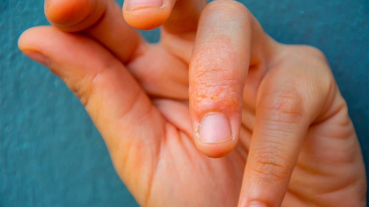 Skin peeling on fingertips: 10 causes