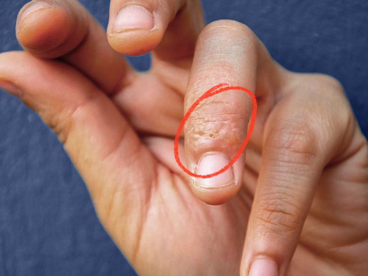 2-145 Eczema nails – note vesicular dermatitis and transverse grooves on  the nail