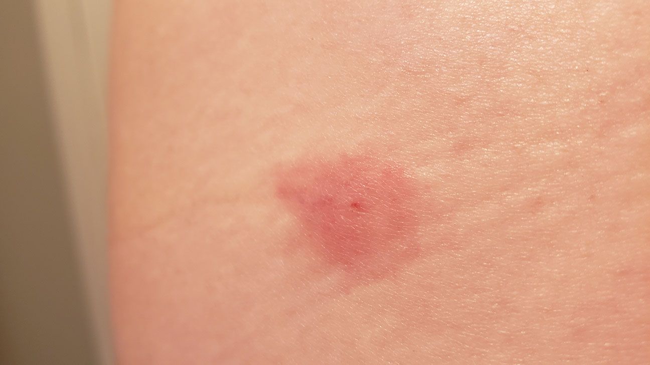 Hives vs. rash: Pictures, differences, and symptoms