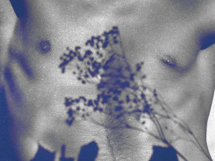 Seborrheic dermatitis affecting skin on chest: Symptoms and treatment