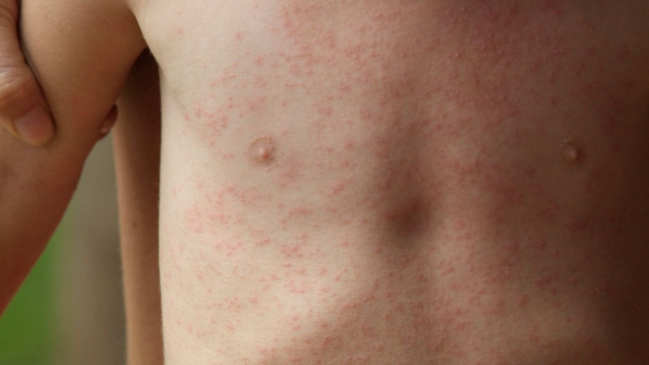 Photograph of a patient who developed moderate-to-severe allergic