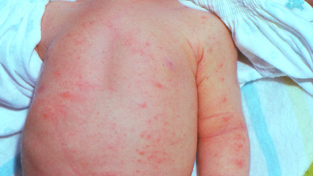 Rashes & spots (pictures) in toddlers, children & babies - NHS doctor  identified