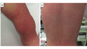Rash★ Fifth disease (erythema infectiosum) rash: Malar rash and