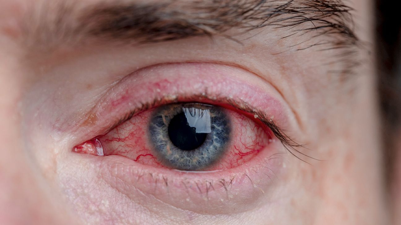 Pink eye: What are the first symptoms?