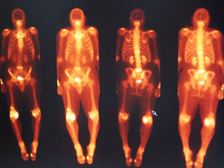 How common is cardiac amyloidosis? Bone scan study examines prevalence