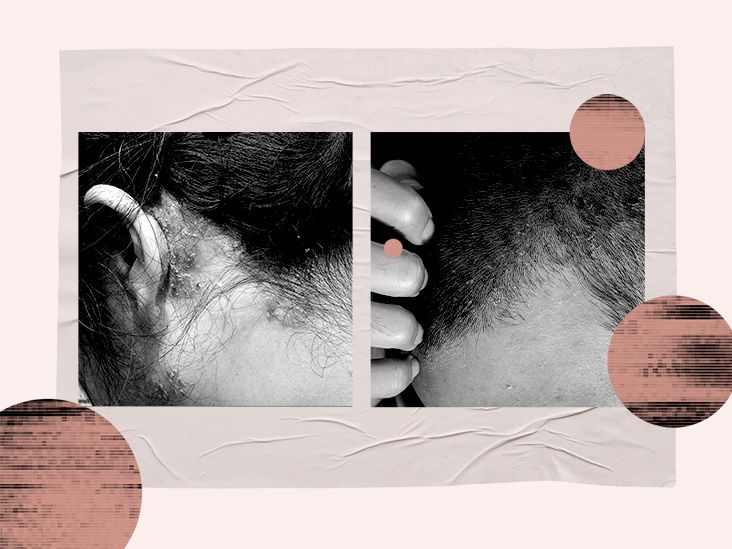 Scalp eczema vs. psoriasis Differences, pictures and treatment