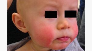 Rash★ Fifth disease (erythema infectiosum) rash: Malar rash and