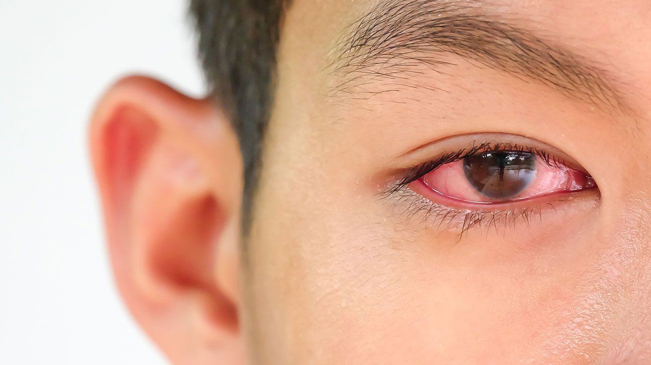 Telling the Difference Between Pink Eye & Styes