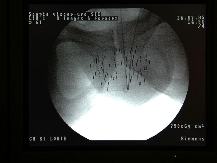 Brachytherapy For Prostate Cancer What To Expect