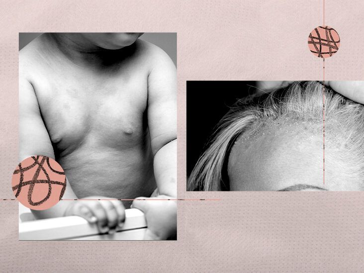 4 DoctorApproved Ways To Get Rid Of Itchy Balls
