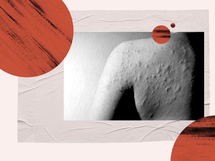 What is cholinergic urticaria and how is it treated?