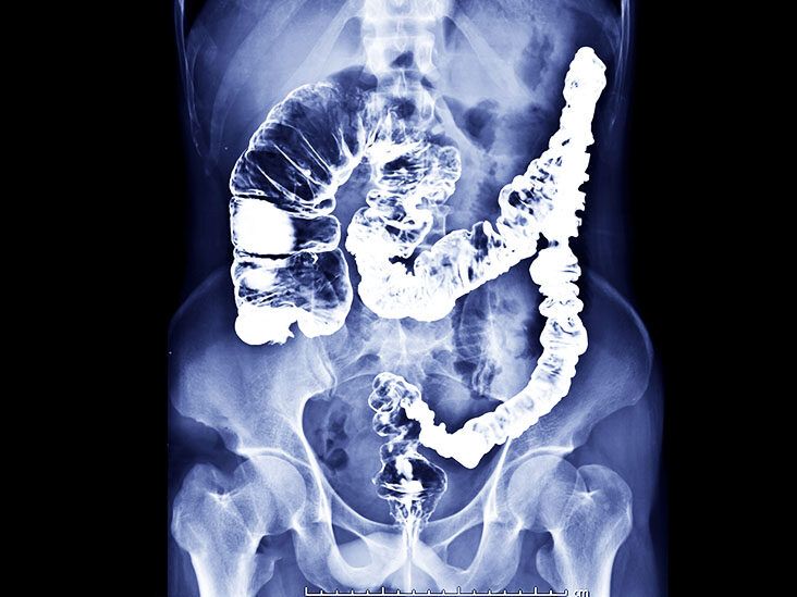 Fecal impaction, Radiology Reference Article