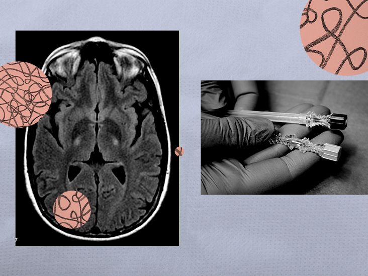 ALS treatment: FDA approves drug toferson for one type of the disease