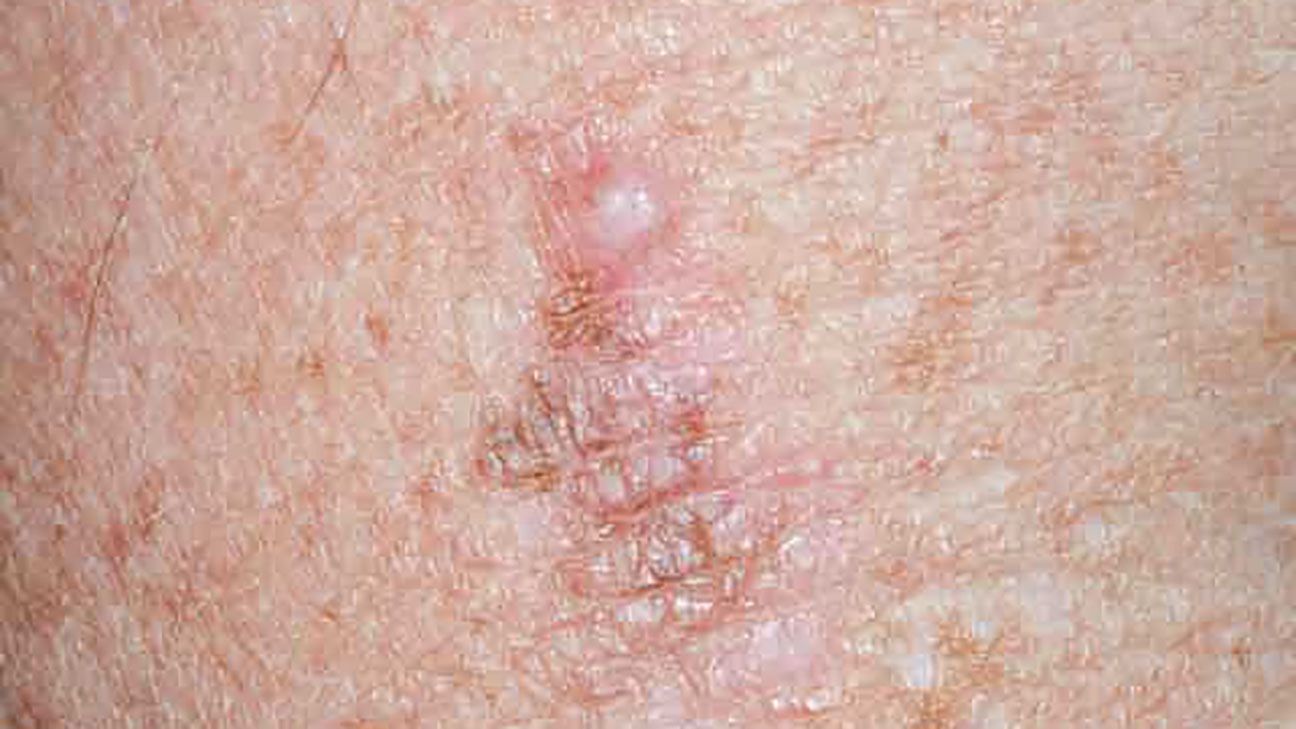 Viral Rash: Types, Symptoms, Causes, Diagnosis, Treatment and More