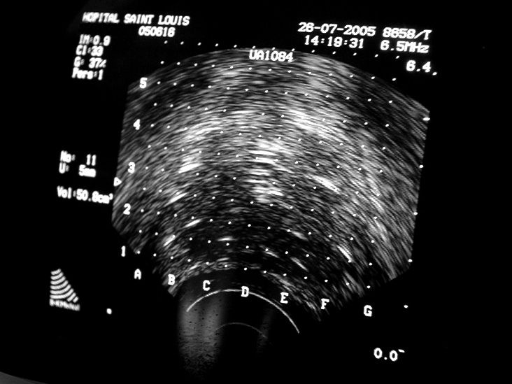 Brachytherapy for cervical cancer