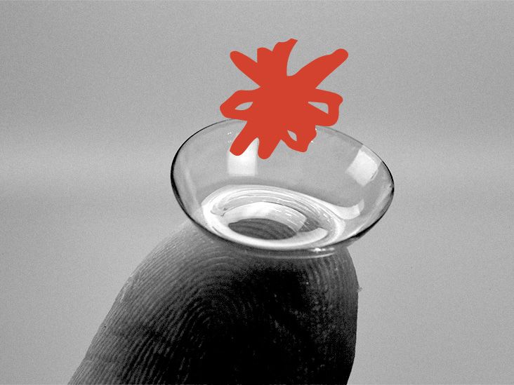 The link between contact lenses and headaches