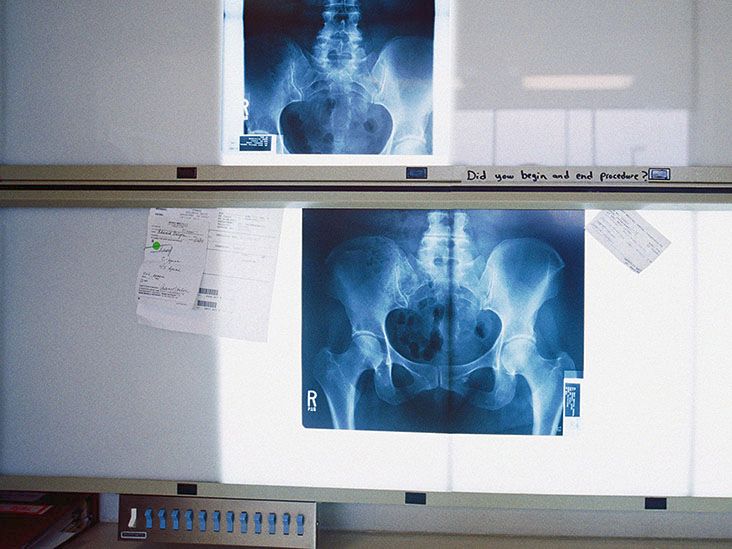 Rapidly destructive osteoarthritis: Types and causes