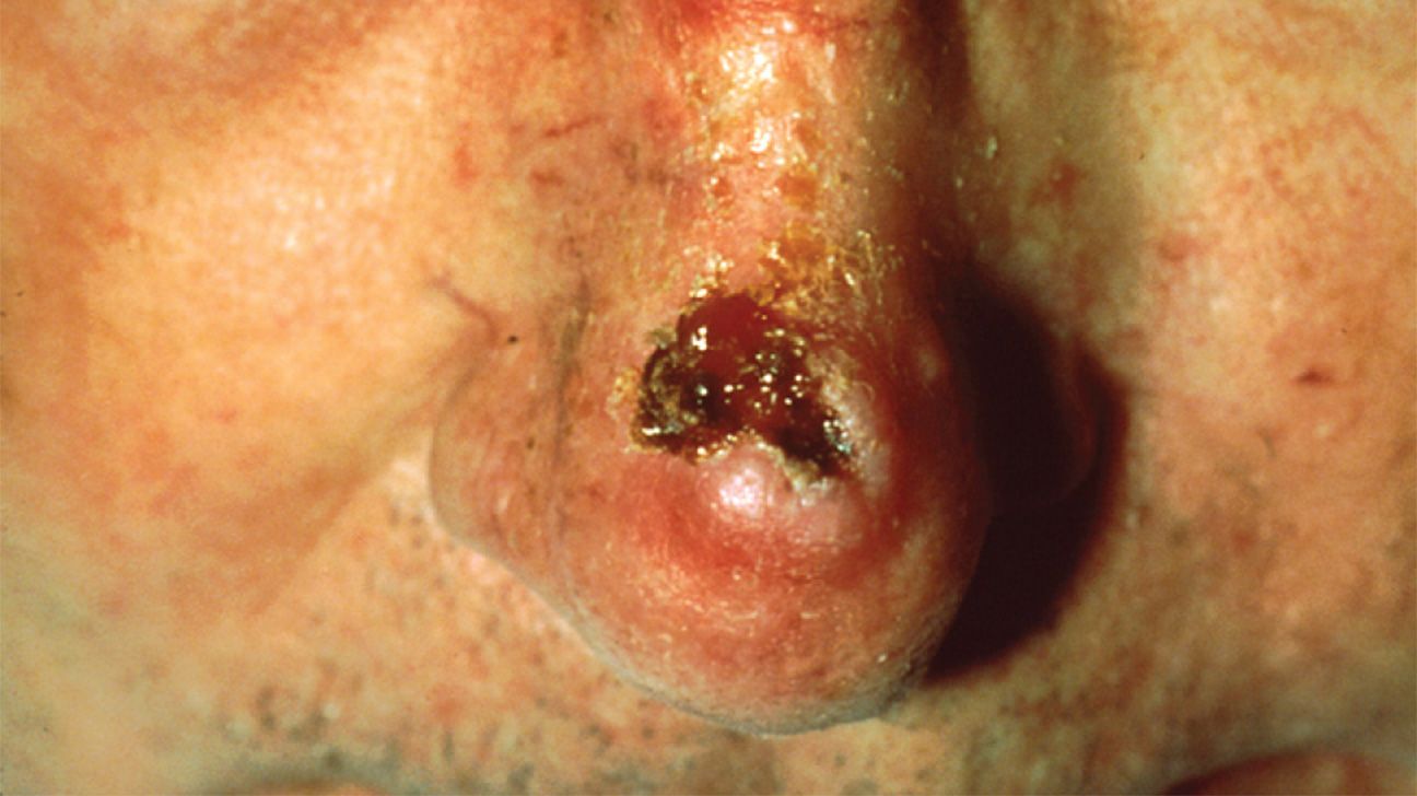 melanoma inside nose