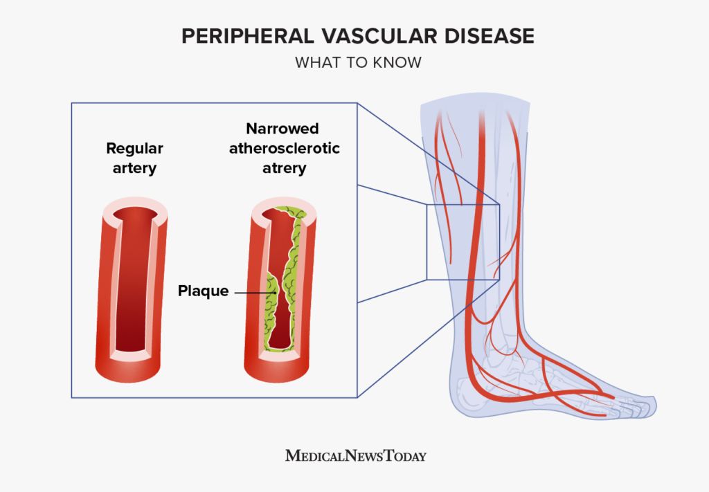 illustration to depict peripheral vascular disease.