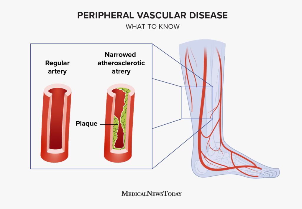 Peripheral vascular disease Causes symptoms and treatment