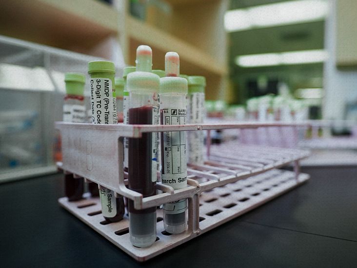 Intraepithelial lymphocytosis: Causes, treatment, FAQs, and more