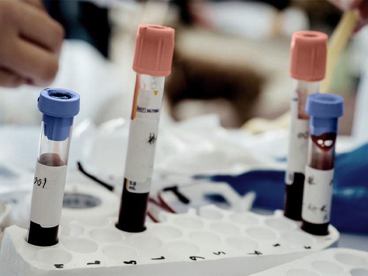 Blood tests for psoriatic arthritis Types, results, and next steps