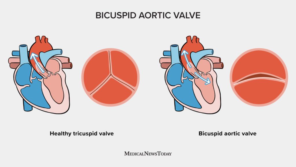 An illustration of bicuspid aortic valve.