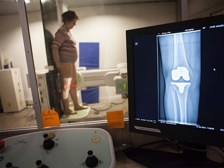 Artificial knee What it is, how long it lasts, and the risks