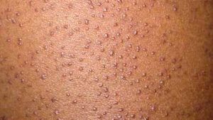 Keratosis Pilaris and Black Skin: Pictures, Treatment, Causes