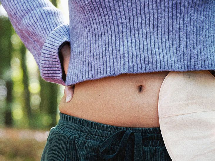 Ileostomy: Preparation, recovery, and what to expect