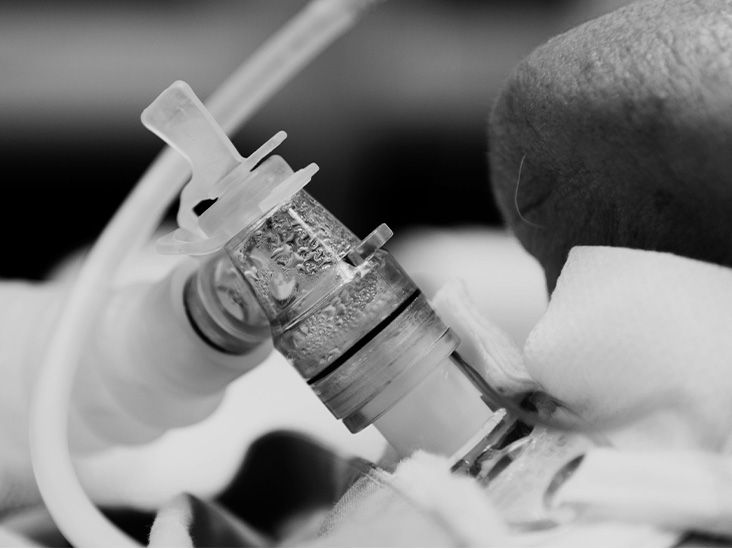 Tracheostomy suctioning What to know