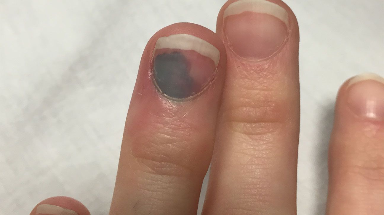 Paroxysmal finger hematoma | Cleveland Clinic Journal of Medicine