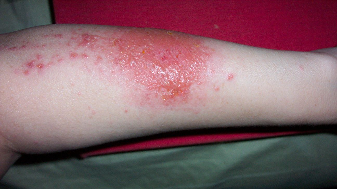 Allergic reaction heat rash  What causes it and how is it treated? -  us.klarify