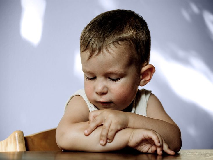 Is eczema contagious? Eczema types, treatments, and FAQs