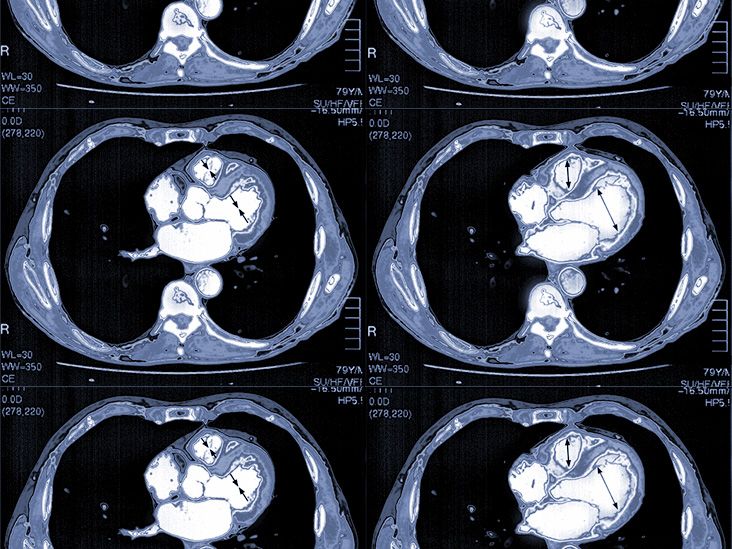 What Does A Cardiac CT Scan Show or Detect and When Do You Need It? -  UChicago Medicine