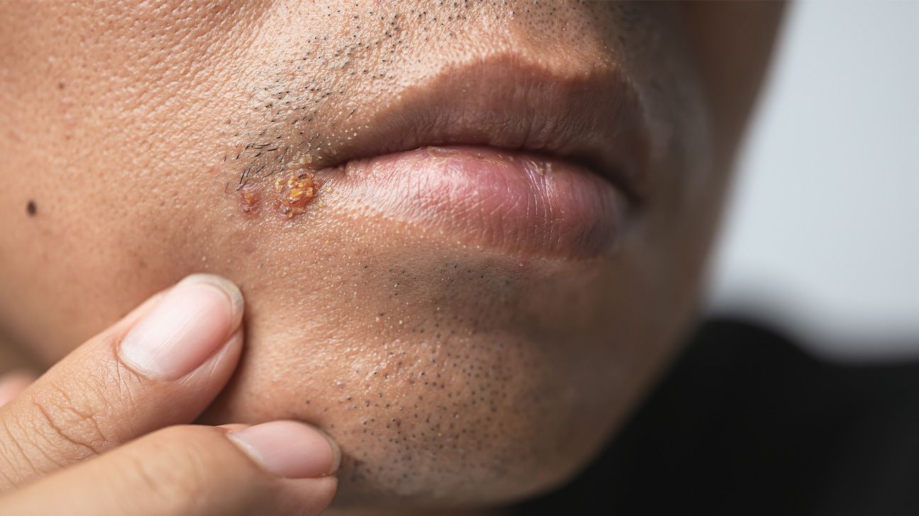 herpes on cheek of face