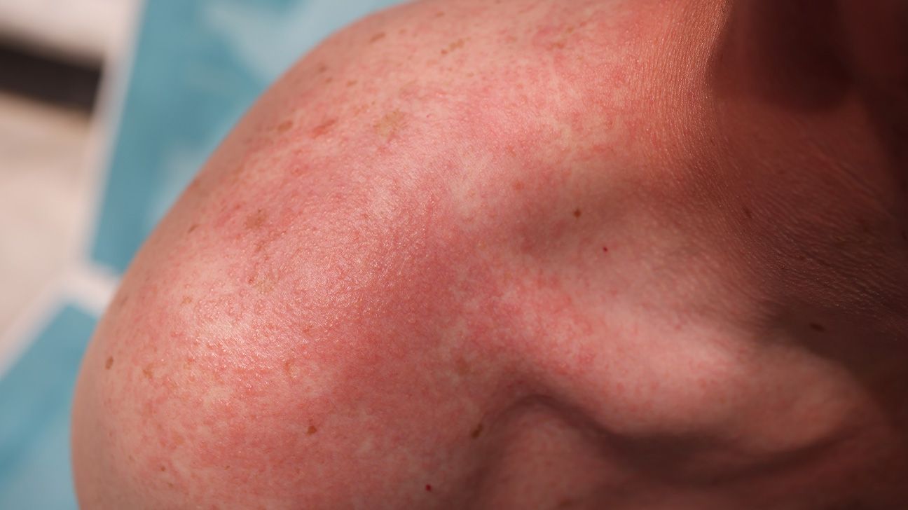 13 Causes of Red Spots on Skin