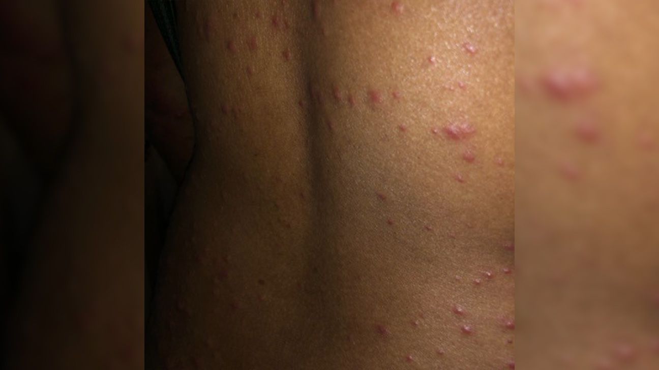 small red dots on chest, should i be concerned? : r/Dermatology