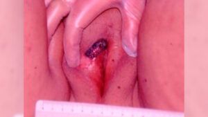 melanotic nodule Images of Amelanotic Melanoma  DermNet