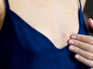 Hives On The Breast Causes Symptoms And More