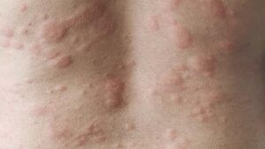 Hives on the breast: Causes, symptoms, and more