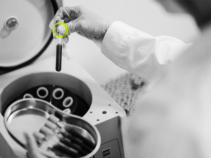 Platelet count blood test Normal, low, and high values