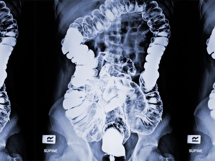 Soap suds enema Safety and how to administer
